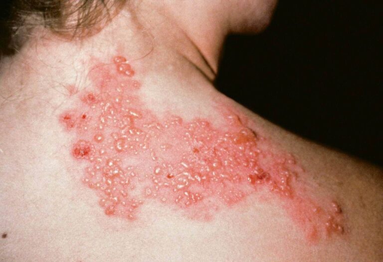 Shingles Disease